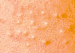 粉刺痘痘